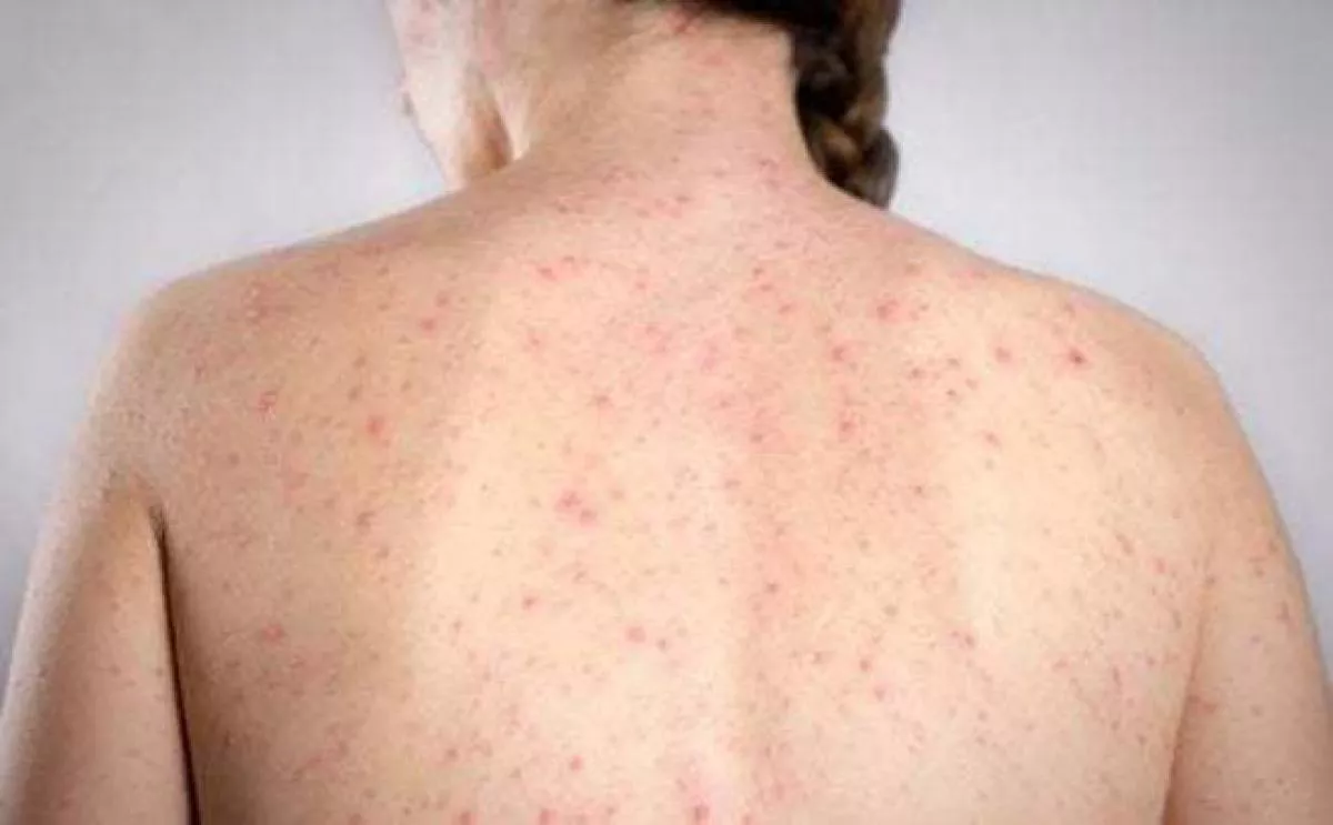 casos de sífilis en Argentina