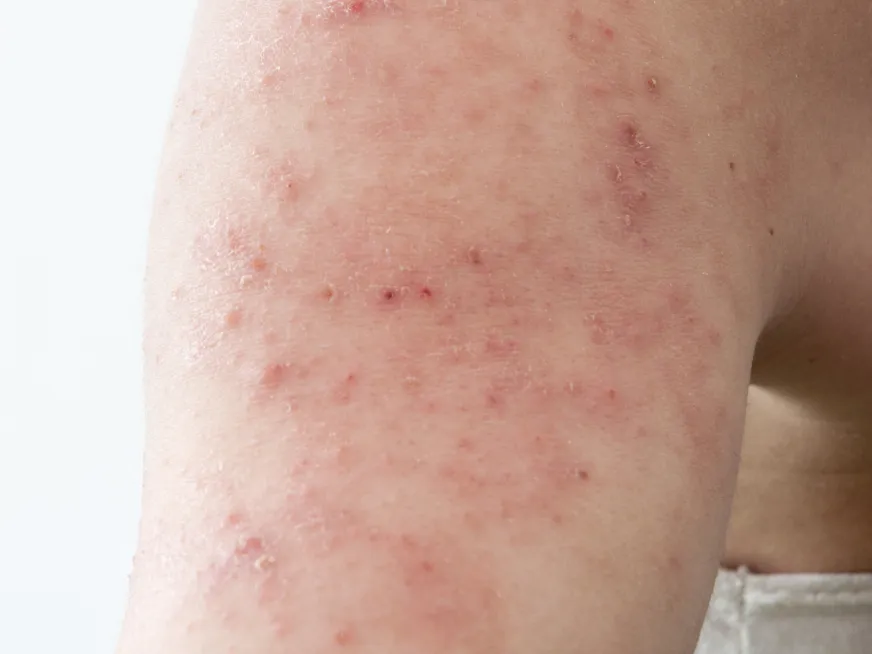 Dermatitis atópica campaña