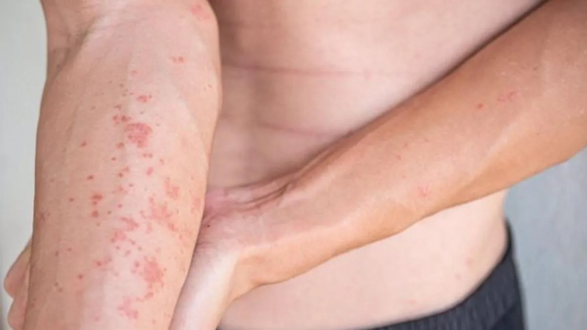Dermatitis atópica