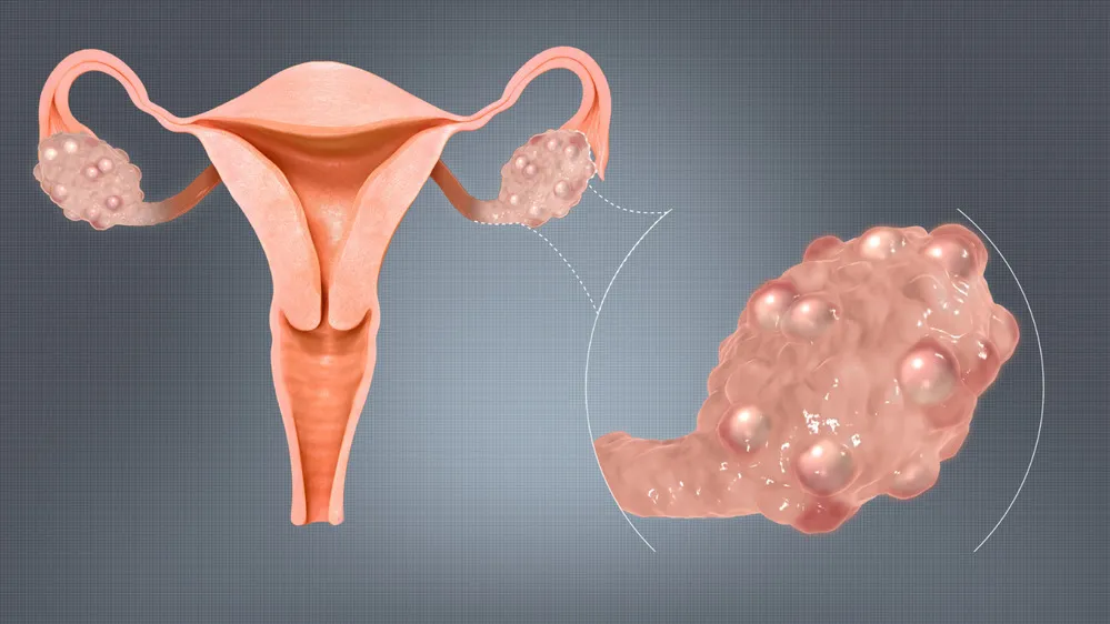 EL OBJETIVO FOTO CANCER DE OVARIO LABORATORIO BAGO Ovarios-cancer