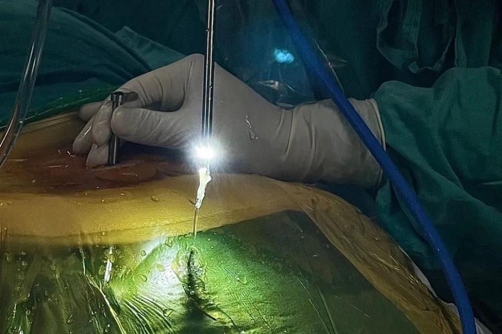 EL OBJETIVO FOTO CIRUGIA ENDOSCOPICA DE COLUMNA 1