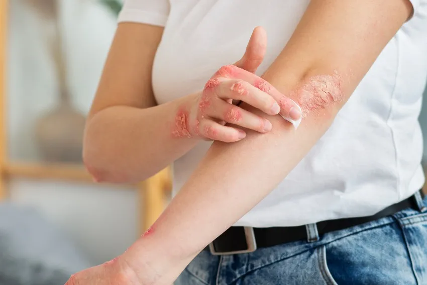 psoriasis_
