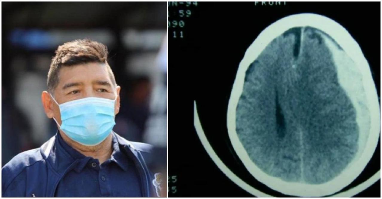 hematoma subdural Maradona